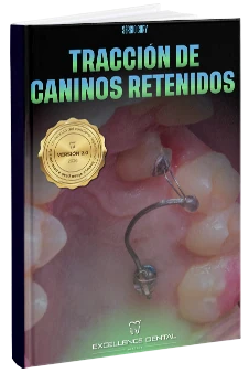 Manual de tracción de caninos retenidos